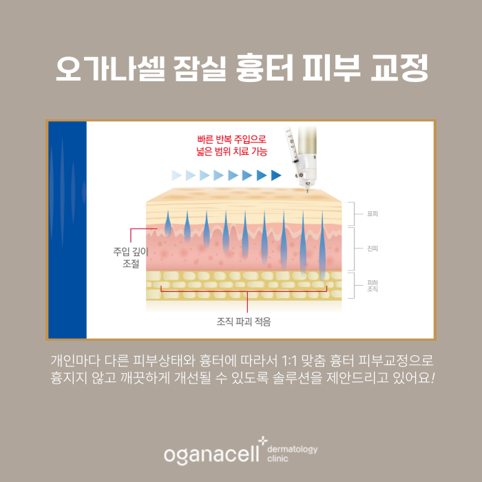 여드름 흉터 교정 20대 전후 비교 실제사례 관련 이미지 6