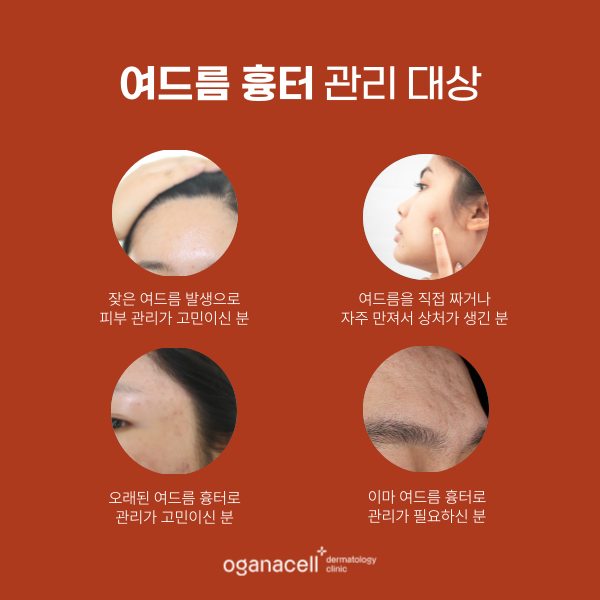이마여드름흉터 개선 - 잠실피부과 관리법 관련 이미지 3