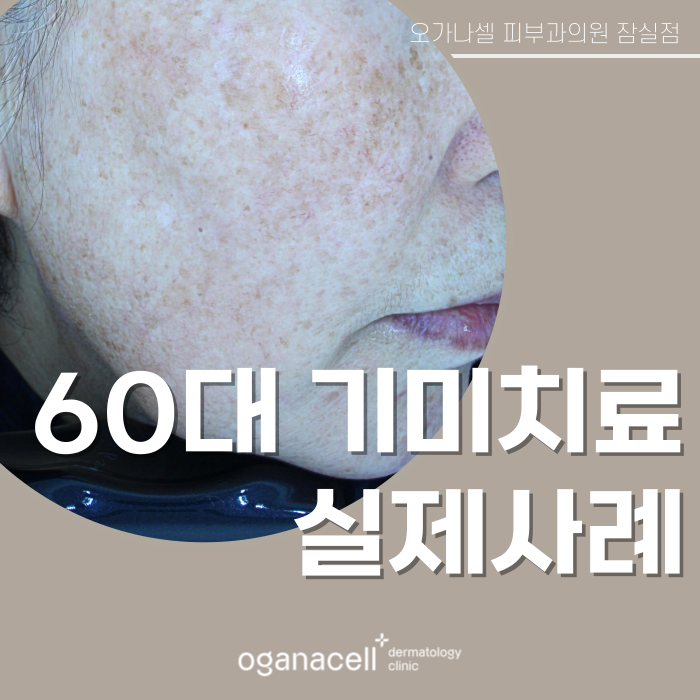 60대 기미 제거 전후 비교 실제사례 관련 이미지 1