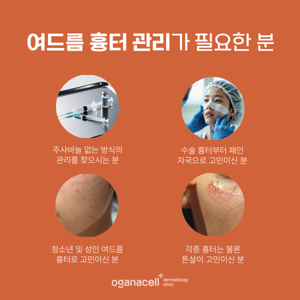 여드름 흉터 관리법 : 홈케어 및 잠실피부과 관리 관련 이미지 3