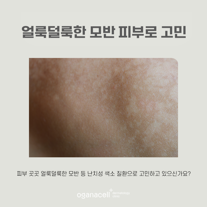 난치성색소질환 특징에 따른 맞춤 교정 관련 이미지 6
