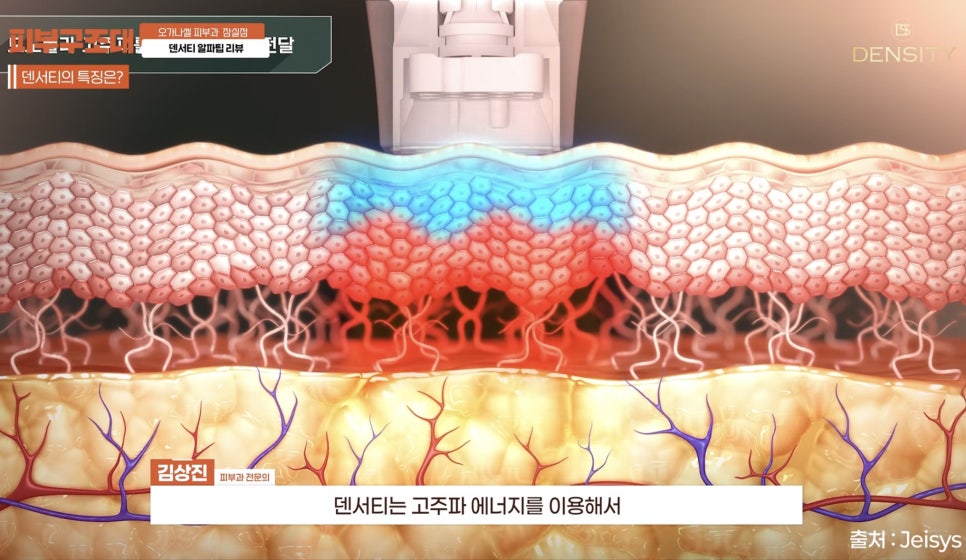 잠실피부과전문의 꿀팁 가성비리프팅 무엇일까? 관련 이미지 2