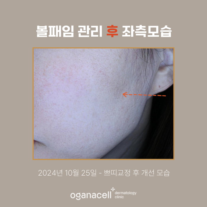 잠실역 스컬트라 관리 실제사례 후기 관련 이미지 5