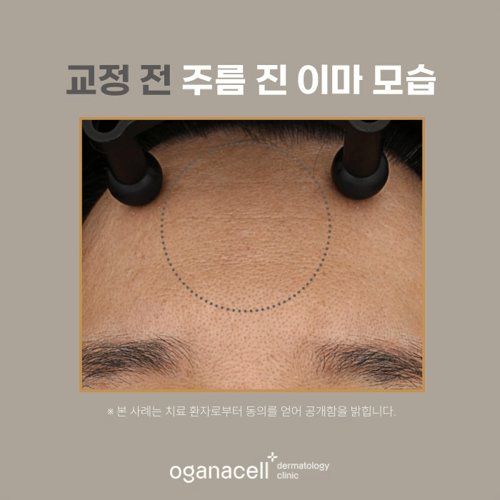 잠실보톡스 이마 쁘띠교정 전후 모습 비교 관련 이미지 4