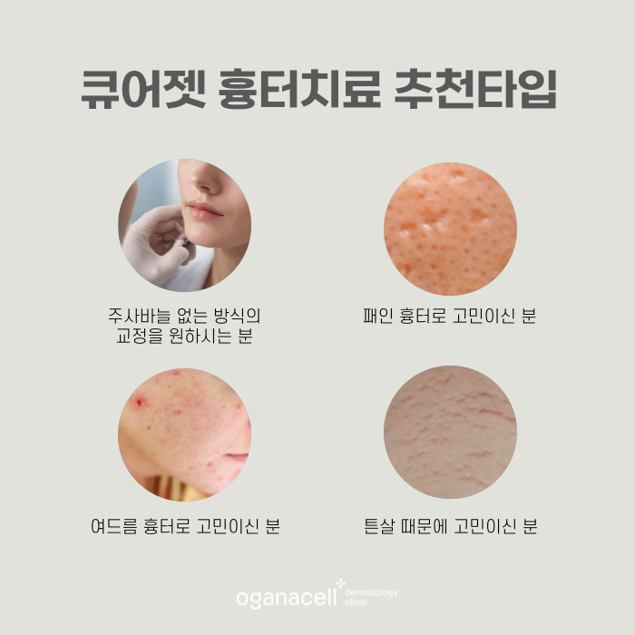 잠실새내 흉터치료 큐어젯 하는 곳 관련 이미지 3