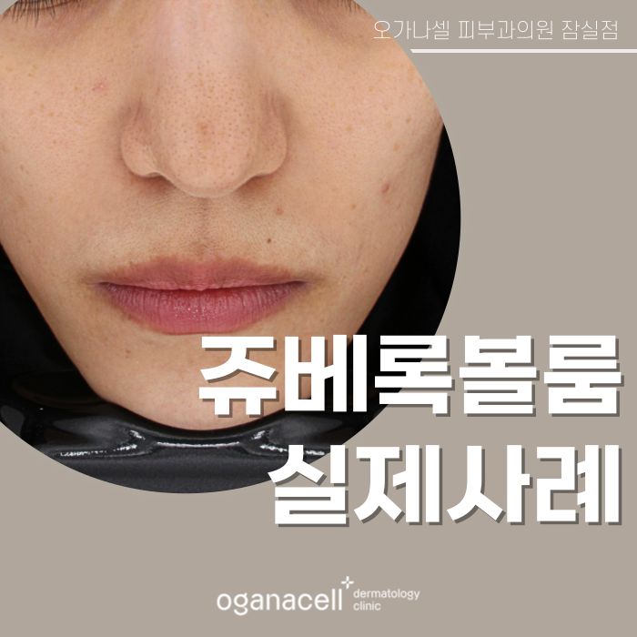 잠실쥬베룩볼륨 전후 비교 실제사례 관련 이미지 1