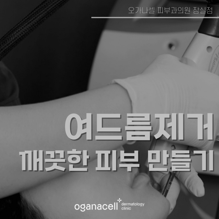 여드름제거 방법 원인부터 없애는 게 좋아요 관련 이미지 1