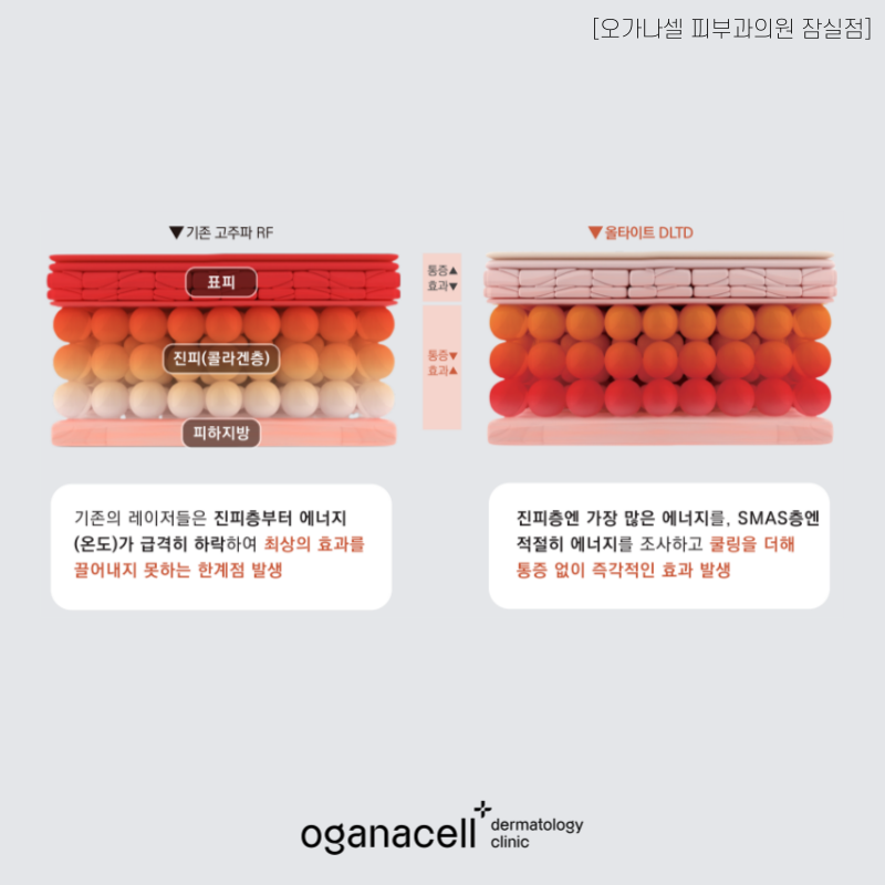 잠실피부과 울타이트 리프팅 원리 및 특별 안내 관련 이미지 3