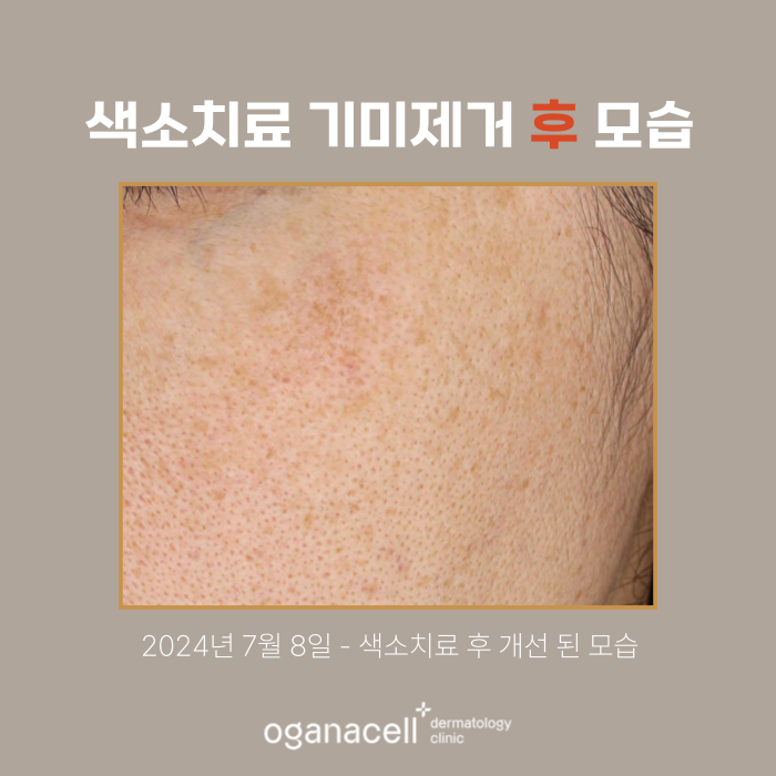 잠실역색소치료 색소제거 전후 비교 후기 관련 이미지 3