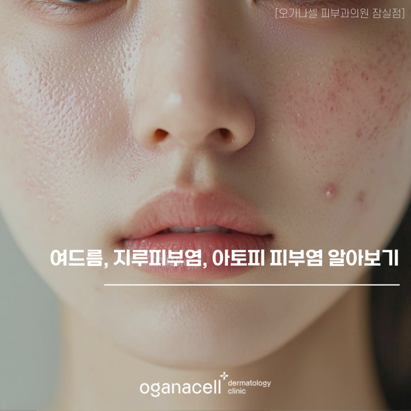 피부 질환 정보 - 여드름, 지루피부염, 아토피 피부염 관련 이미지 1