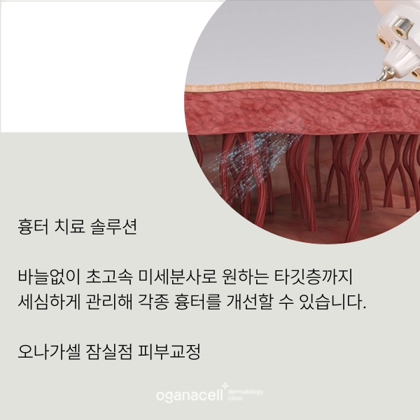 흉터 안 아프게 없애는 법 관련 이미지 6
