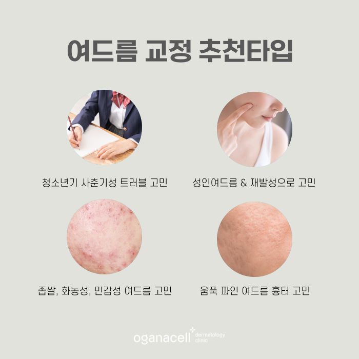 여드름제거 방법 원인부터 없애는 게 좋아요 관련 이미지 5