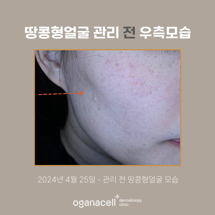 잠실역 스컬트라 관리 실제사례 후기 관련 이미지 2