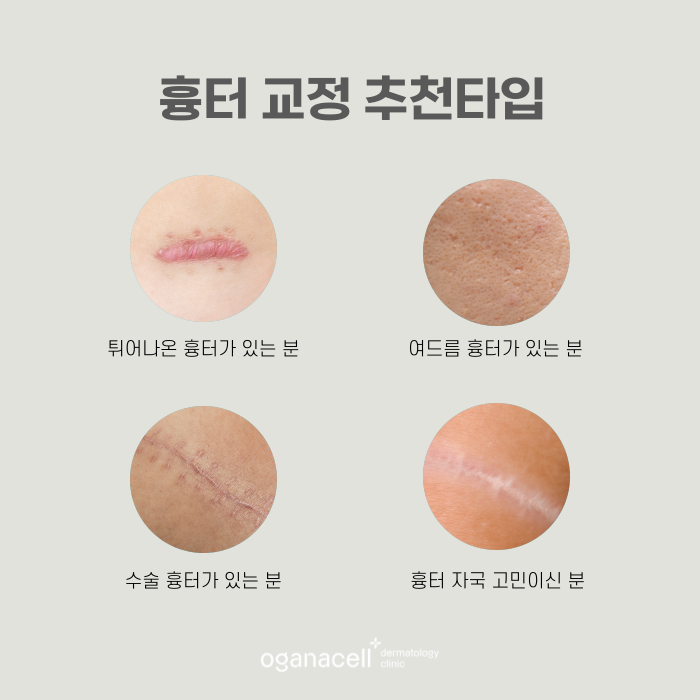 잠실흉터치료잘하는곳 오가나셀 관련 이미지 3