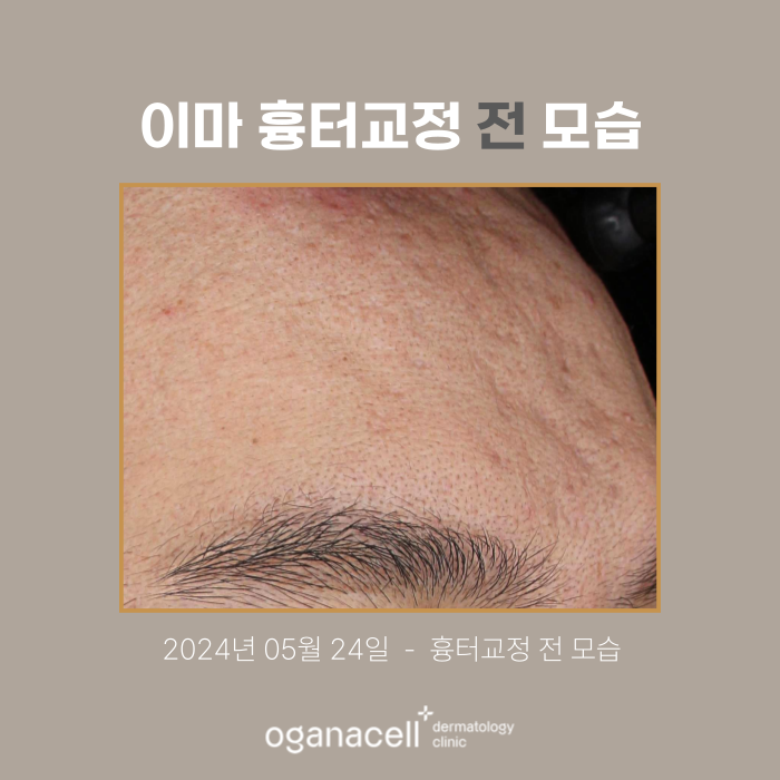Forehead Scar Correction: Actual Case Before and After Comparison image 2