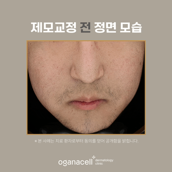잠실 남자수염제모 피부과 관리 전후 비교 관련 이미지 5