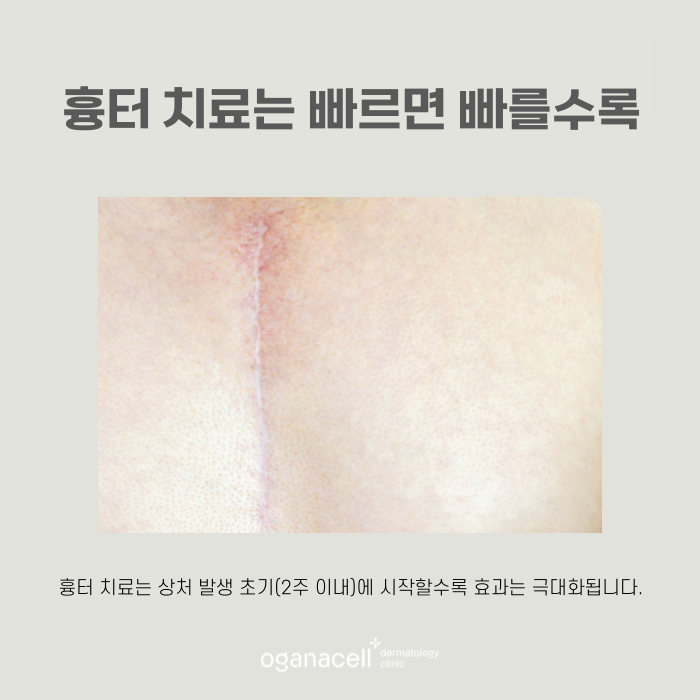튀어나온 흉터 켈로이드 특징과 치료 시기 관련 이미지 7