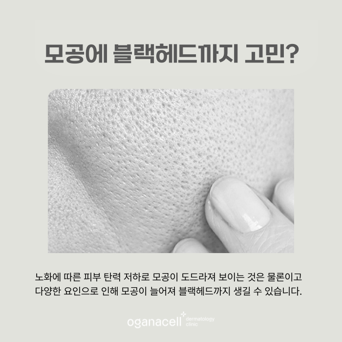 코의피지 제거하는 방법 원인부터 개선해야 관련 이미지 4