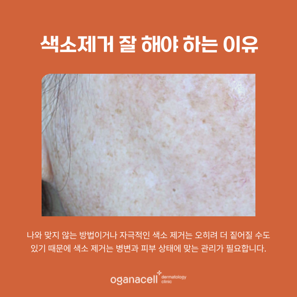 기미 색소 제거 잘하는 잠실 피부과 관련 이미지 5