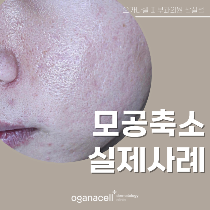 송파구모공피부과 관리 전후 실제사례 후기 관련 이미지 1