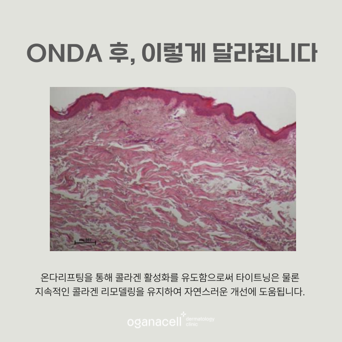 잠실온다리프팅 얼굴, 목, 바디 고민 개선 방법 관련 이미지 6