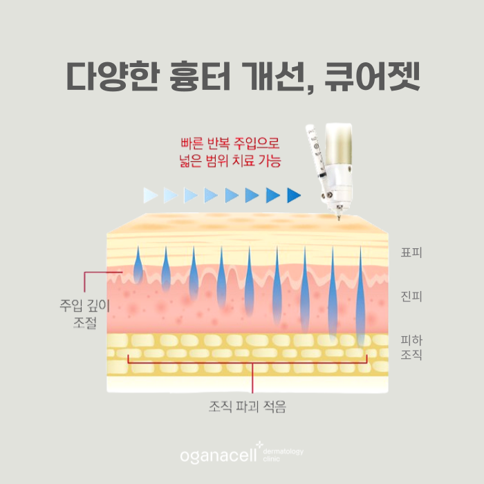 잠실큐어젯 흉터교정 방법 관련 이미지 7
