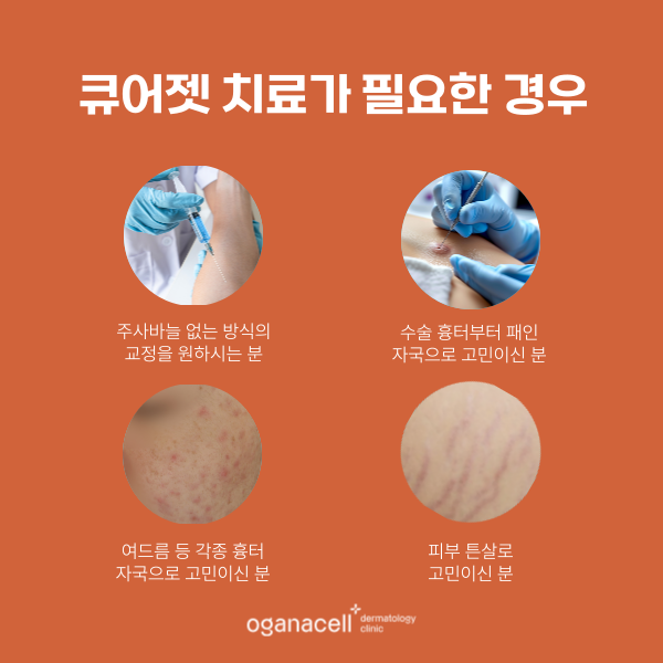 잠실 여드름흉터 제거하는 방법 관련 이미지 3