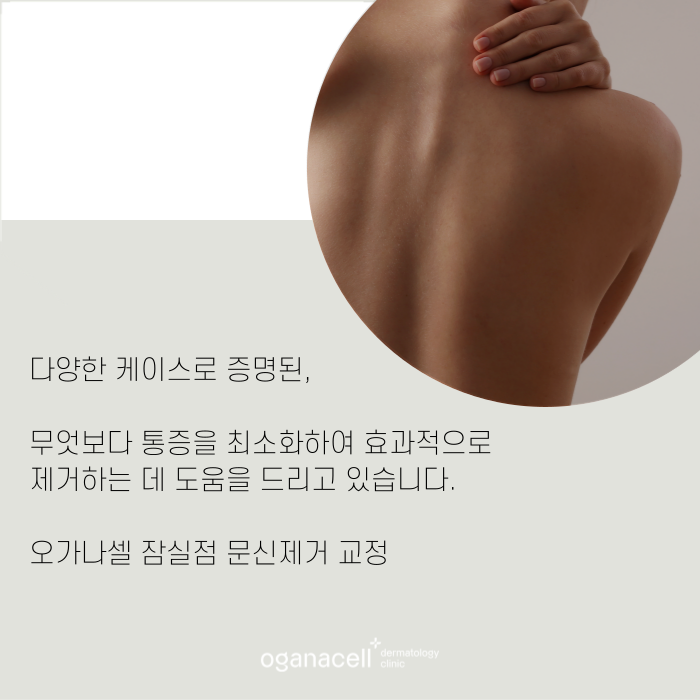 잠실역1번출구 문신제거 잘하는 곳 관련 이미지 9