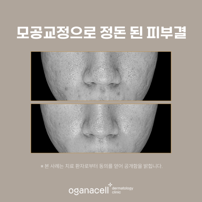 송파구모공피부과 관리 전후 실제사례 후기 관련 이미지 4