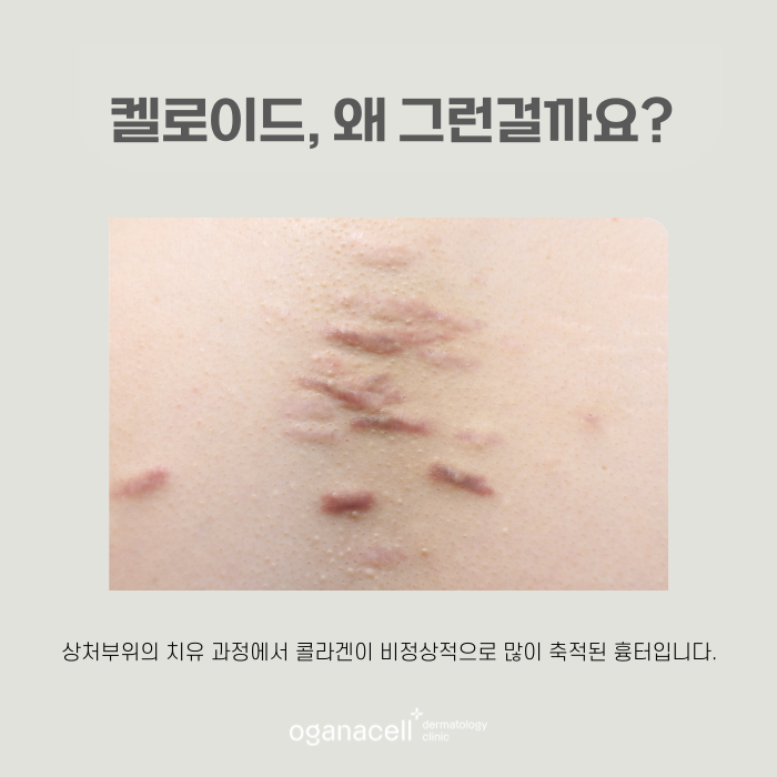 튀어나온 흉터 켈로이드 특징과 치료 시기 관련 이미지 6