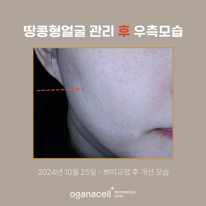 잠실역 스컬트라 관리 실제사례 후기 관련 이미지 3