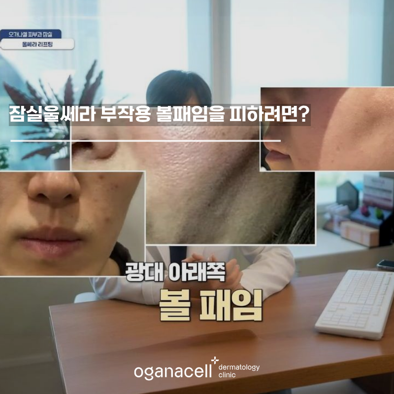 잠실울쎄라 부작용 볼패임을 피하려면? 관련 이미지 1