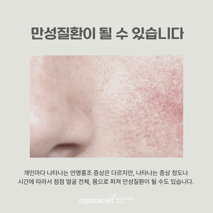 잠실 안면홍조 원인 알고 관리해야 하는 이유 관련 이미지 5