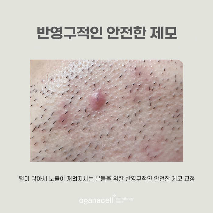 수염 등 제모하기 전에 알아두면 좋은 꿀팁 관련 이미지 6
