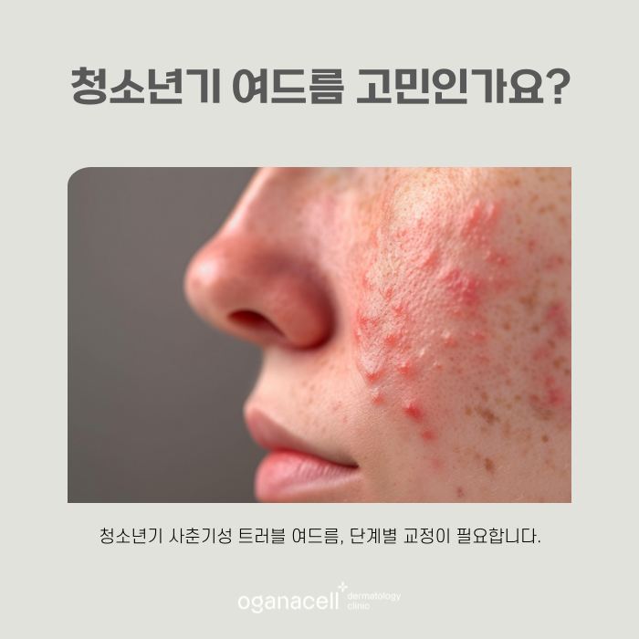 여드름제거 방법 원인부터 없애는 게 좋아요 관련 이미지 6