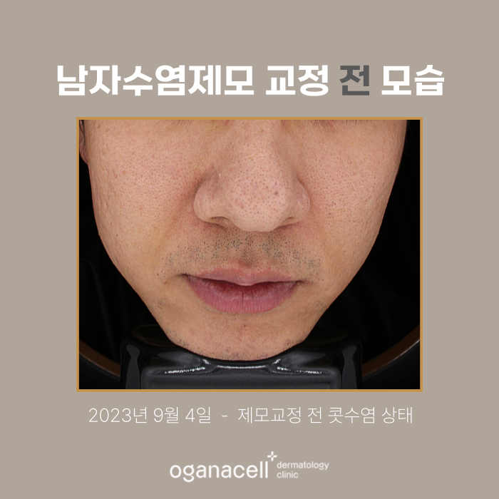 잠실남자제모 전후 비교 후기 관련 이미지 2