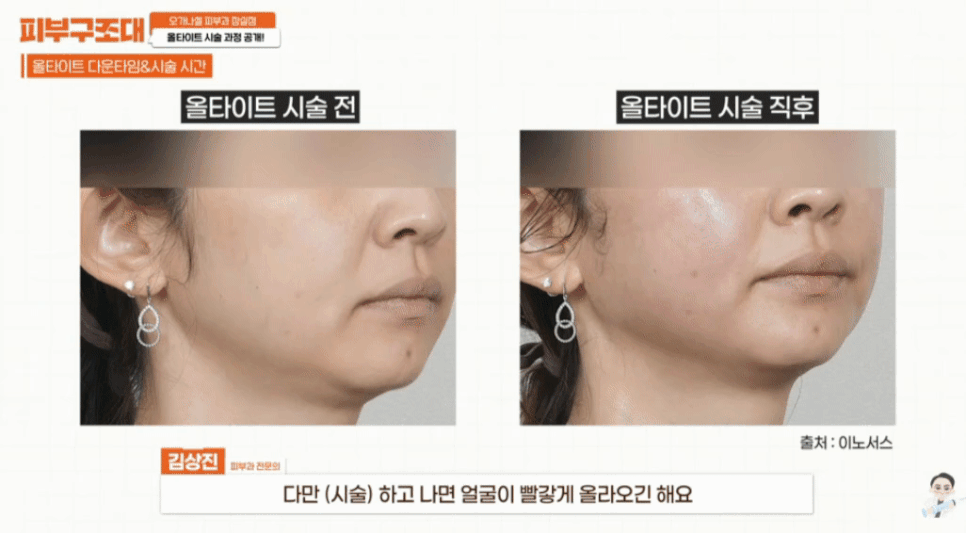 리프팅 입문 가성비 올타이트 후기 공개 관련 이미지 6