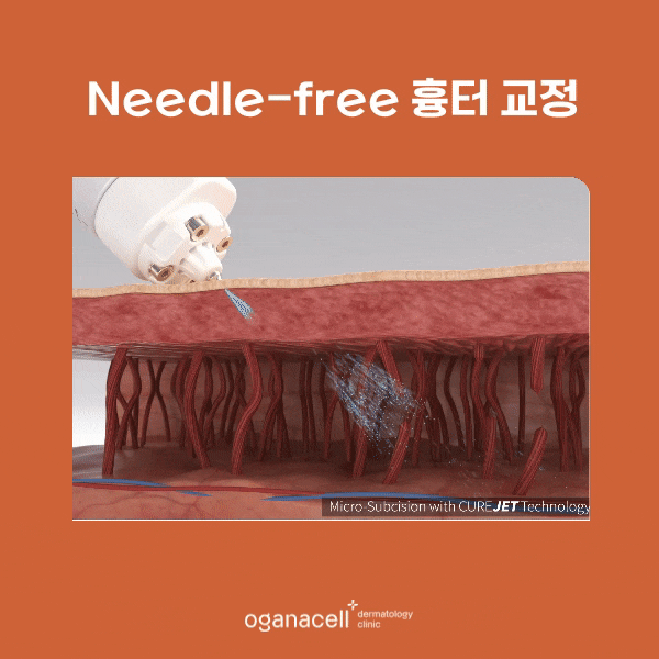 잠실 여드름흉터 제거하는 방법 관련 이미지 6