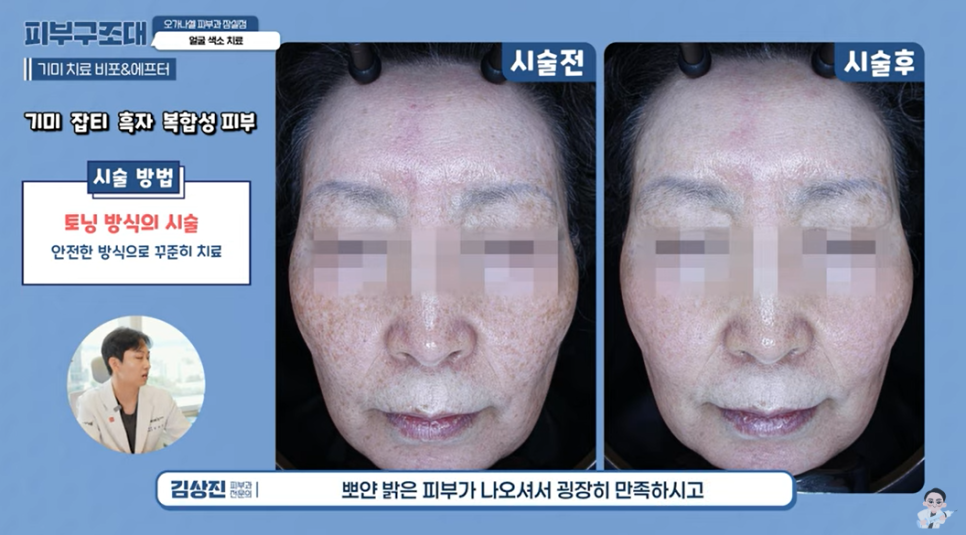 잠실색소제거 점 사마귀 검버섯 잡티 주근깨 맞춤 관리 관련 이미지 10