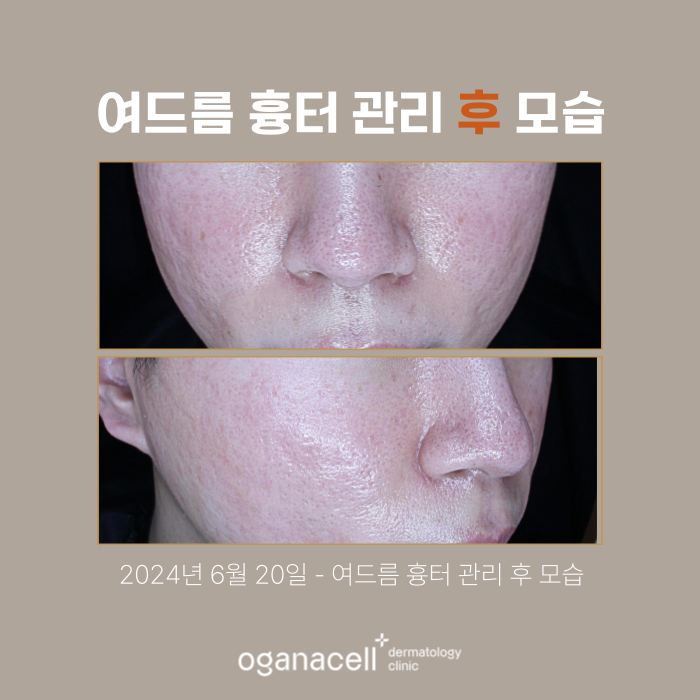 남자여드름피부 잠실피부과 흉터교정 전후 비교 관련 이미지 3