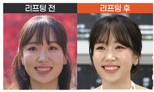 잠실역인근피부과 올타이트리프팅 있는 곳 관련 이미지 7