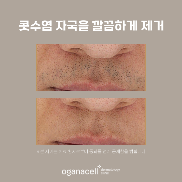 잠실남자제모 전후 비교 후기 관련 이미지 4