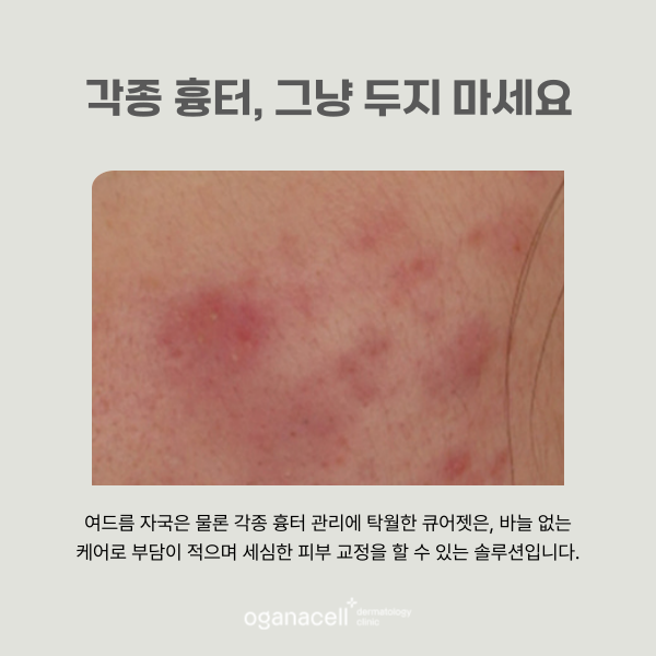 흉터 안 아프게 없애는 법 관련 이미지 4