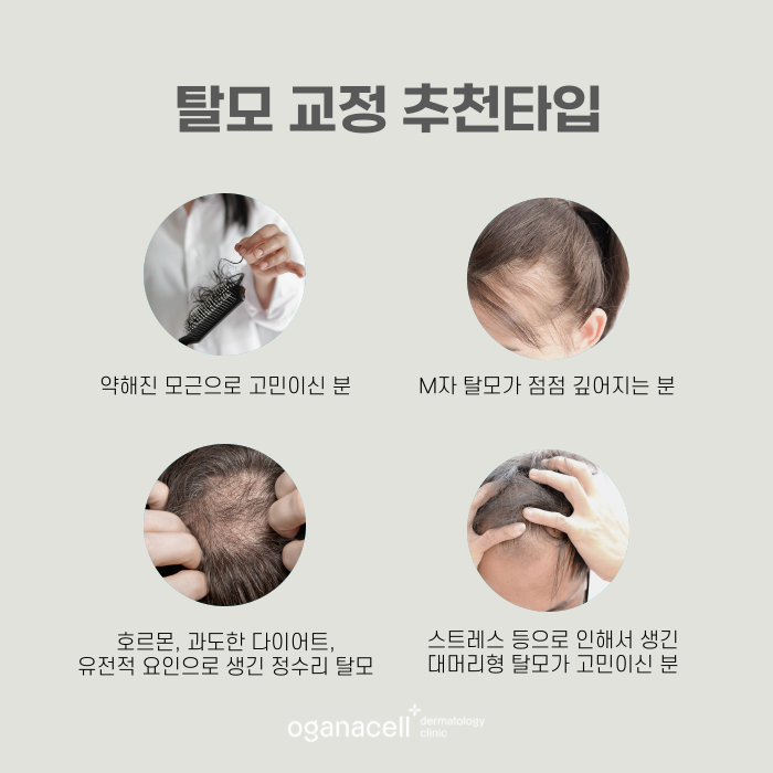 M자부터 정수리까지 자신감을 채워주는 잠실피부과 관련 이미지 5