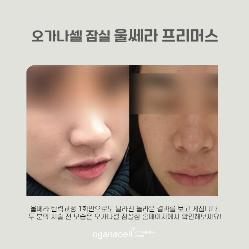 강력리프팅 1회만으로도 달라지는 팁 관련 이미지 6