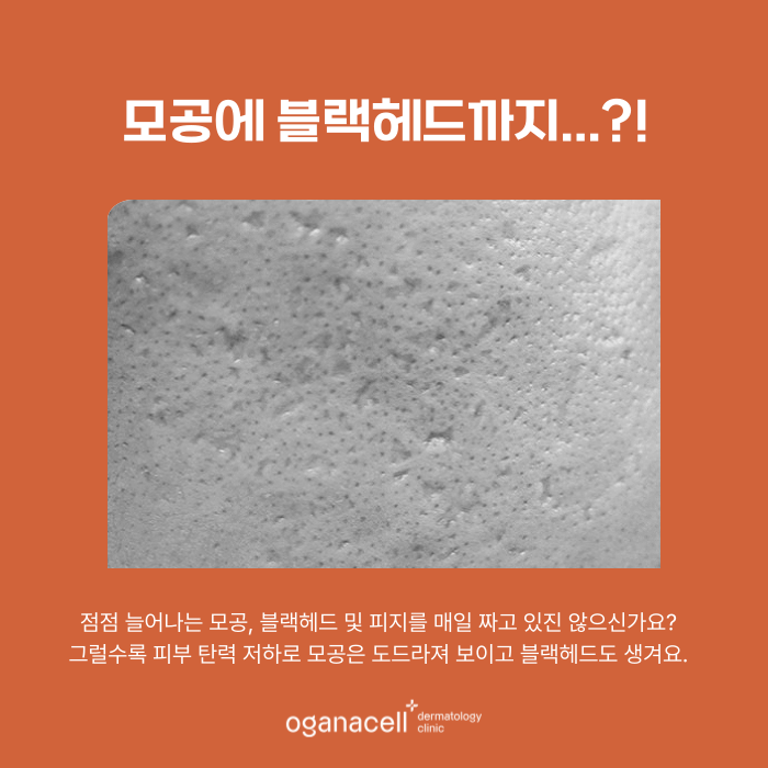 곰보피부 모공 축소보다 알아야 할 핵심 관련 이미지 4