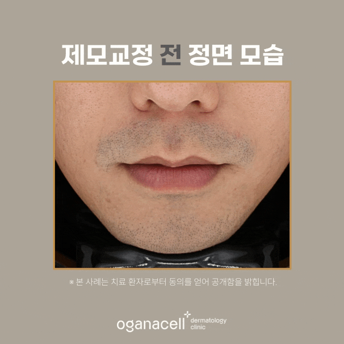 잠실역피부과 제모 남자수염 실제사례(+피부톤개선) 관련 이미지 5