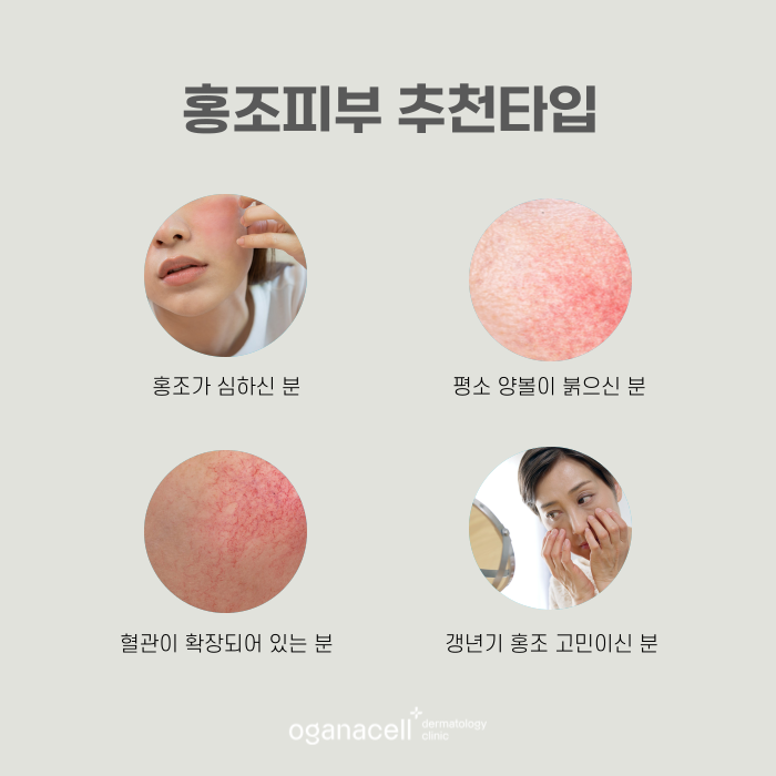 잠실 안면홍조 유형과 원인에 따라 교정해 주는 곳 관련 이미지 3