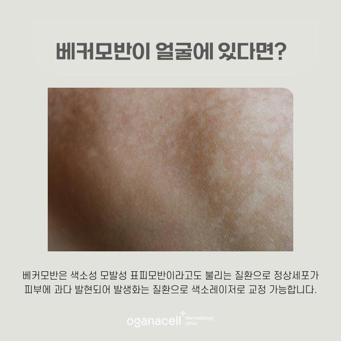 얼굴모반 우리아이한테도 보인다면 관련 이미지 5