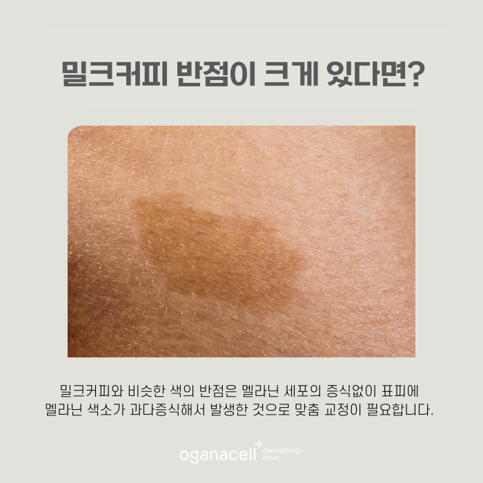 얼굴모반 우리아이한테도 보인다면 관련 이미지 4
